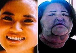Korean Woman's Face Deformed After DIY Cooking Oil Injections